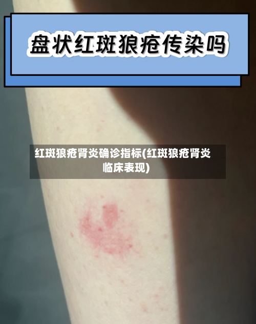 红斑狼疮肾炎确诊指标(红斑狼疮肾炎临床表现)