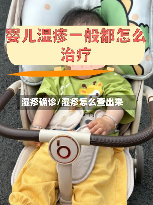 湿疹确诊/湿疹怎么查出来-第3张图片