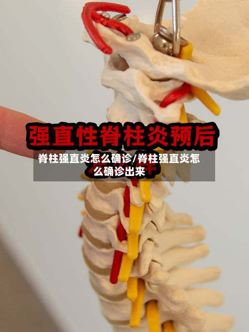 脊柱强直炎怎么确诊/脊柱强直炎怎么确诊出来-第2张图片