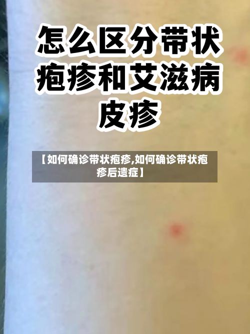 【如何确诊带状疱疹,如何确诊带状疱疹后遗症】-第2张图片