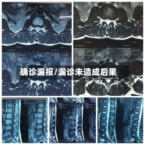 确诊漏报/漏诊未造成后果