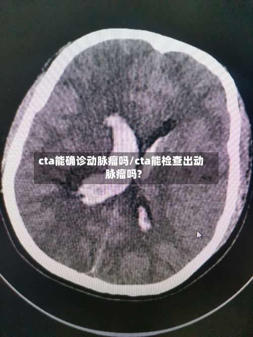 cta能确诊动脉瘤吗/cta能检查出动脉瘤吗?-第2张图片