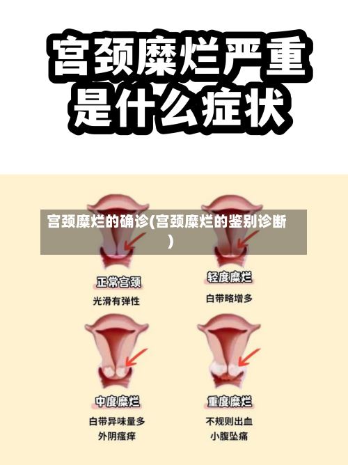 宫颈糜烂的确诊(宫颈糜烂的鉴别诊断)-第2张图片