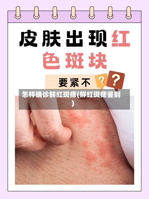 怎样确诊鲜红斑痣(鲜红斑痣鉴别)