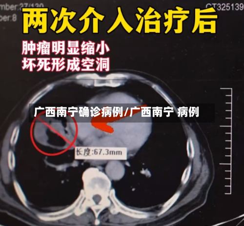 广西南宁确诊病例/广西南宁 病例-第2张图片
