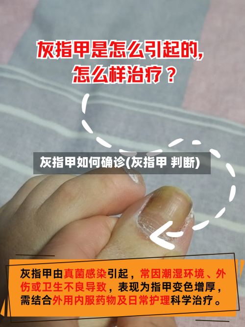 灰指甲如何确诊(灰指甲 判断)