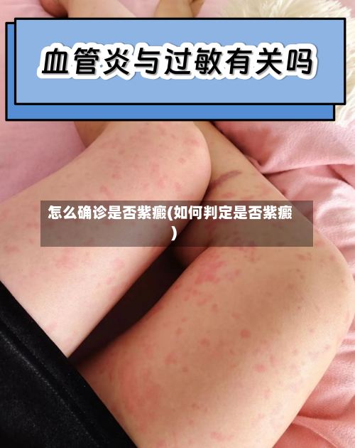 怎么确诊是否紫癜(如何判定是否紫癜)
