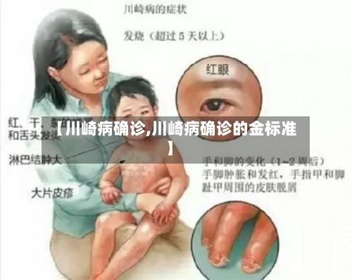 【川崎病确诊,川崎病确诊的金标准】-第3张图片
