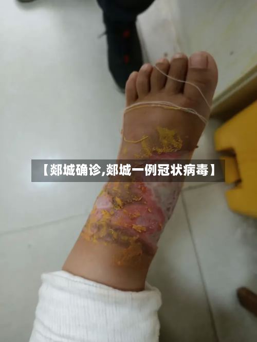 【郯城确诊,郯城一例冠状病毒】-第2张图片