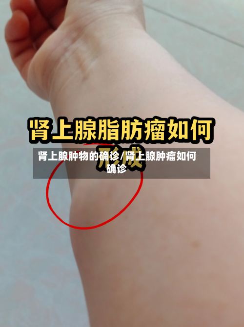 肾上腺肿物的确诊/肾上腺肿瘤如何确诊-第2张图片