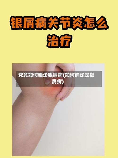 究竟如何确诊银屑病(如何确诊是银屑病)-第2张图片