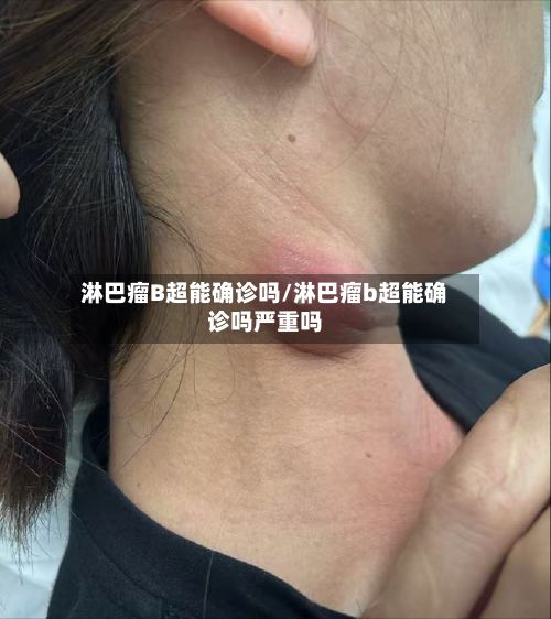 淋巴瘤B超能确诊吗/淋巴瘤b超能确诊吗严重吗